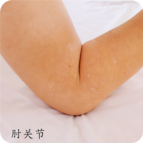 肘关节法